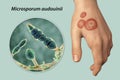 Hand fungal infection, tinea manuum, 3D illustration Royalty Free Stock Photo