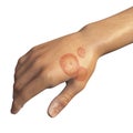 Fungal infection on a man's hand. Tinea manuum