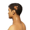 Fungal infection on a man's head, 3D illustration