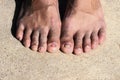 Fungal infection of nail young