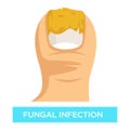 Fungal infection toenail damage suppuration toe vector