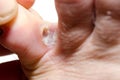 Fungal infection between the toes of the adult man close up