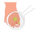 Fungal infections of nails. Vector illustration of skin diseases