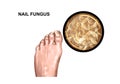 Fungal lesion of the foot Royalty Free Stock Photo