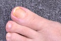 Fungal nail damage.Sore Toes on a dark gray background.ÃÂ¡lose up.Soft focus.Concept of infection and treatment of the fungus of