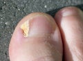 Fungal Nail Infection