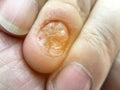 Fungal nail infection and damage on human hand. Finger with onychomycosis, disgusting bitten fingernails on man`s hand.