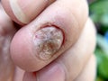 Fungal nail infection and damage on human hand. Finger with onychomycosis, disgusting bitten fingernails on man`s hand.