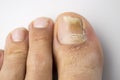 Fungal nail infection Royalty Free Stock Photo