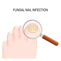 Fungal nail infection