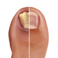 Fungal Nail Infection