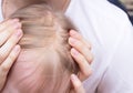 Fungal skin disease seborrheic dermatitis in a child`s head, close-up, seborrhea crust, dermatology Royalty Free Stock Photo