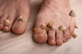 Fungi grow from the nail plates on the feet. Concept of nail fungus, skin and nail infections. Two legs with a fungus close-up in
