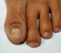 Fungus on the big toe. Fungal disease on the nail psoriasis Royalty Free Stock Photo