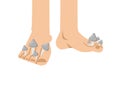 Fungus on feet. Mycosis between fingers. Disease of skin of fingers and feet