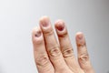 Fungus Infection on Nails Hand, Finger with onychomycosis. - soft focus