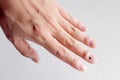 Fungus Infection on Nails Hand, Finger with onychomycosis. - soft focus