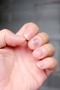 Fungus Infection on Nails Hand, Finger with onychomycosis. - soft focus