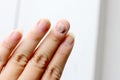 Fungus Infection on Nails Hand, Finger with onychomycosis. - soft focus