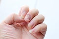 Fungus Infection on Nails Hand, Finger with onychomycosis. - soft focus