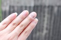 Fungus Infection on Nails Hand, Finger with onychomycosis. - soft focus