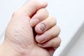 Fungus Infection on Nails Hand, Finger with onychomycosis. - soft focus