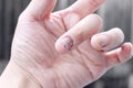 Fungus Infection on Nails Hand, Finger with onychomycosis. - soft focus