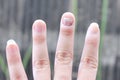Fungus Infection on Nails Hand, Finger with onychomycosis. - soft focus