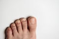 Fungus Infection on Nails of Man's Foot on white background