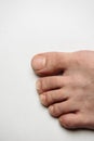 Fungus Infection on Nails of Man's Foot on white background