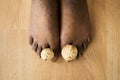 Fungus Mushroom Between Toenail. Smelly Feet Royalty Free Stock Photo