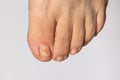 Fungus of nails on the big toe - dermatomycosis and onychomycosis, fungal infection macro photo. Ingrown nail plate. Dermatology, Royalty Free Stock Photo