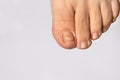 Fungus of nails on the big toe - dermatomycosis and onychomycosis, fungal infection macro photo. Ingrown nail plate. Dermatology, Royalty Free Stock Photo