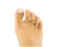 Fungus and toe foot disease