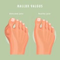 Hallux valgus vector medicine template.