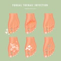 Fungus toenail infection vector medicine poster. Colorful design. Detailed image with text.
