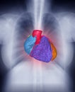 Fusion image of Chest X-ray image and 3D CTA Coronary artery Image.