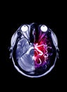 Fusion image MRI and MRA Brain .