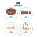 FUT hair loss treatment