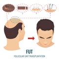 FUT hair loss treatment