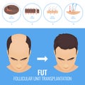 FUT hair loss treatment Royalty Free Stock Photo