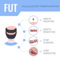 FUT hair transplantation medical infographics for men Royalty Free Stock Photo