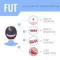 FUT hair transplantation medical infographics for women Royalty Free Stock Photo