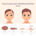 FUT hair transplantation procedure medical infographic poster Royalty Free Stock Photo