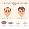 FUT hair transplantation procedure medical infographic poster Royalty Free Stock Photo