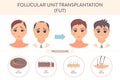 FUT hair transplantation procedure medical infographic poster Royalty Free Stock Photo