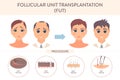 FUT hair transplantation procedure medical infographic poster