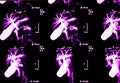 Gall bladder (biliary tract) examination with MRI