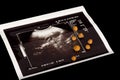 Gall bladder stones with corresponding sonogram