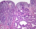 Human gallbladder adenocarcinoma